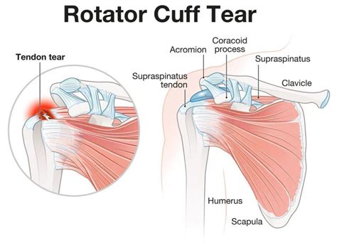 how to test rotator cuff tear|how do i know if need rotator cuff surgery.